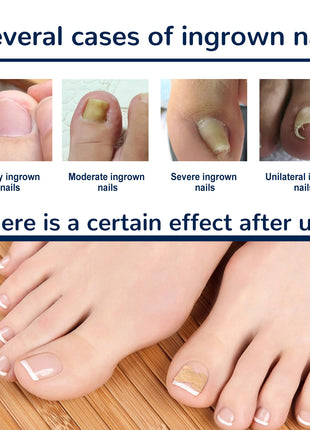Nail Correction Patch, Nail Insert Correction And Repair Toe Manicure Nail Patch
