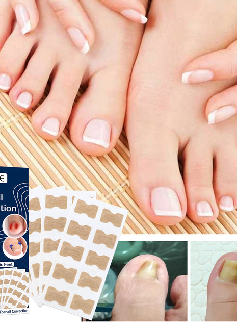 Nail Correction Patch, Nail Insert Correction And Repair Toe Manicure Nail Patch