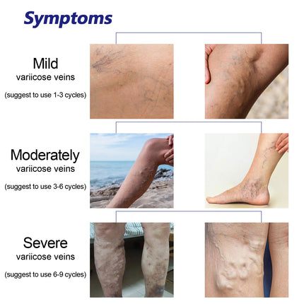 Intravenous Spray, Relief Of Varicose Blood Vessel Bulge Pain Intravenous Massage Treatment Spray