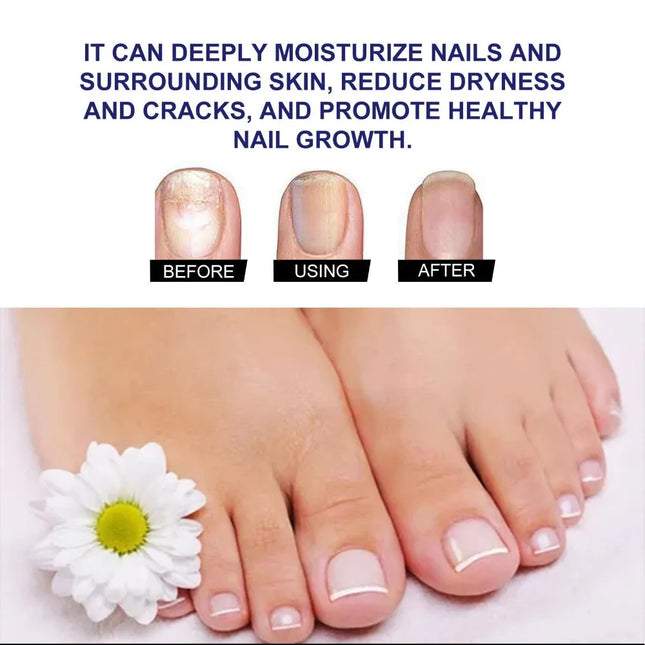 10ml Nail Fungus Repair Nail Care Liquid Hands Soft Nails Nail Care Moisturizer Feet Brightens Nails Nail Drops