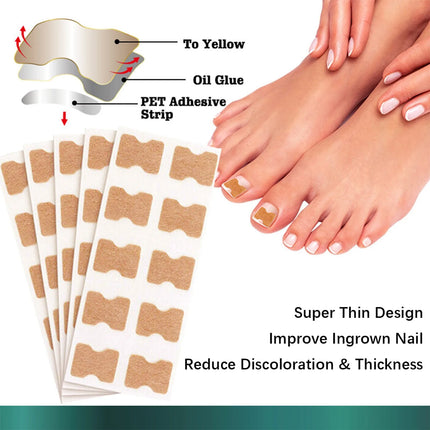Ingrown Toenail Correction Stickers Hands And Feet Soft Nail Inlaid Nail Thickening Bright Nail Furrow Gray Nail Care Patch 50pc